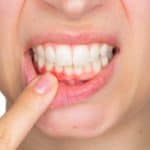 woman indicates gum irritation
