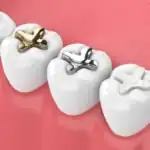 3D illustration of molar teeth with gold, silver, and composite dental fillings